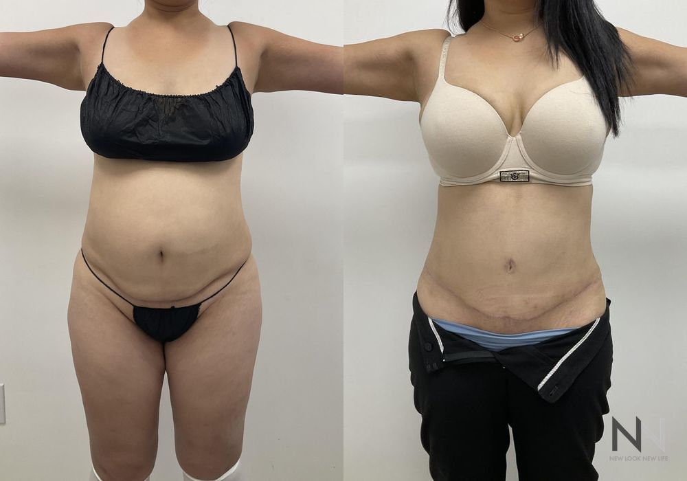 Tummy Tuck - Thumbnail 3