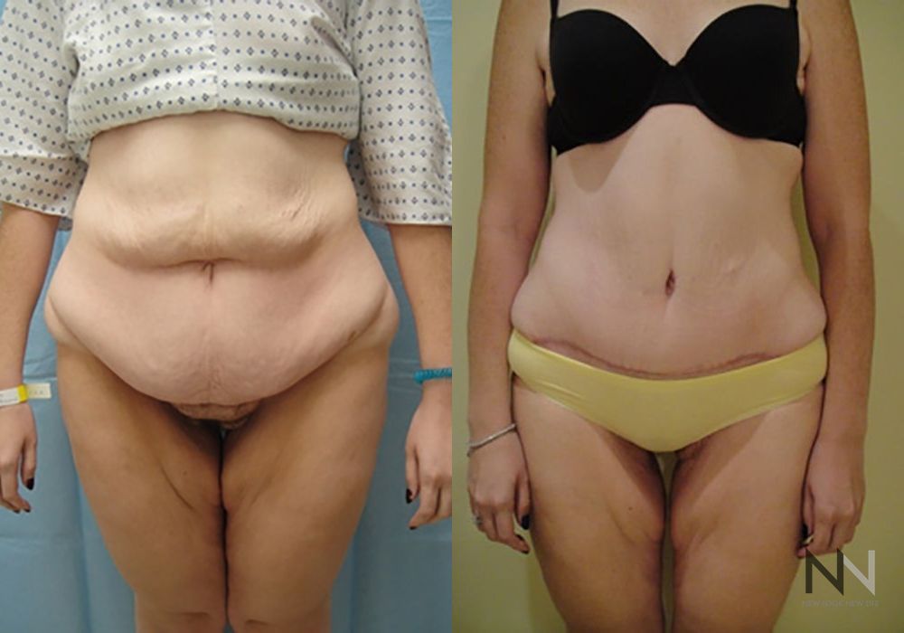 Tummy Tuck - Thumbnail 2