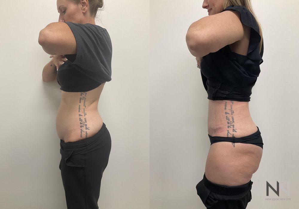 Tummy Tuck - Thumbnail 3