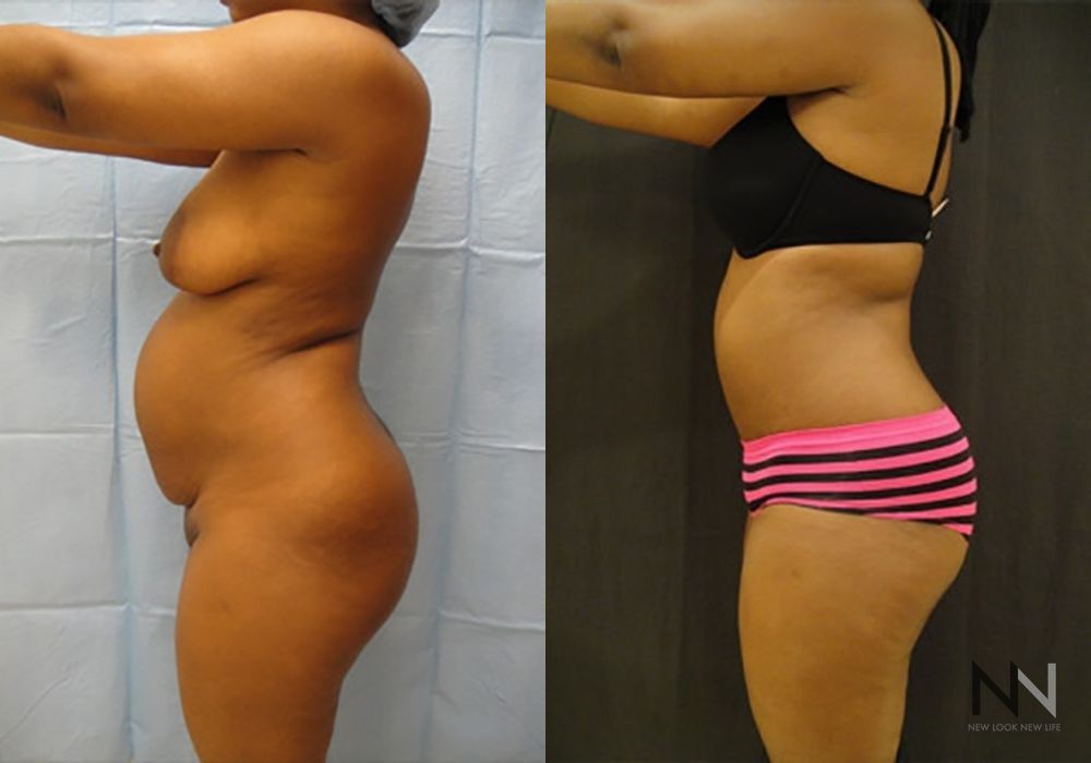 Tummy Tuck - Thumbnail 2