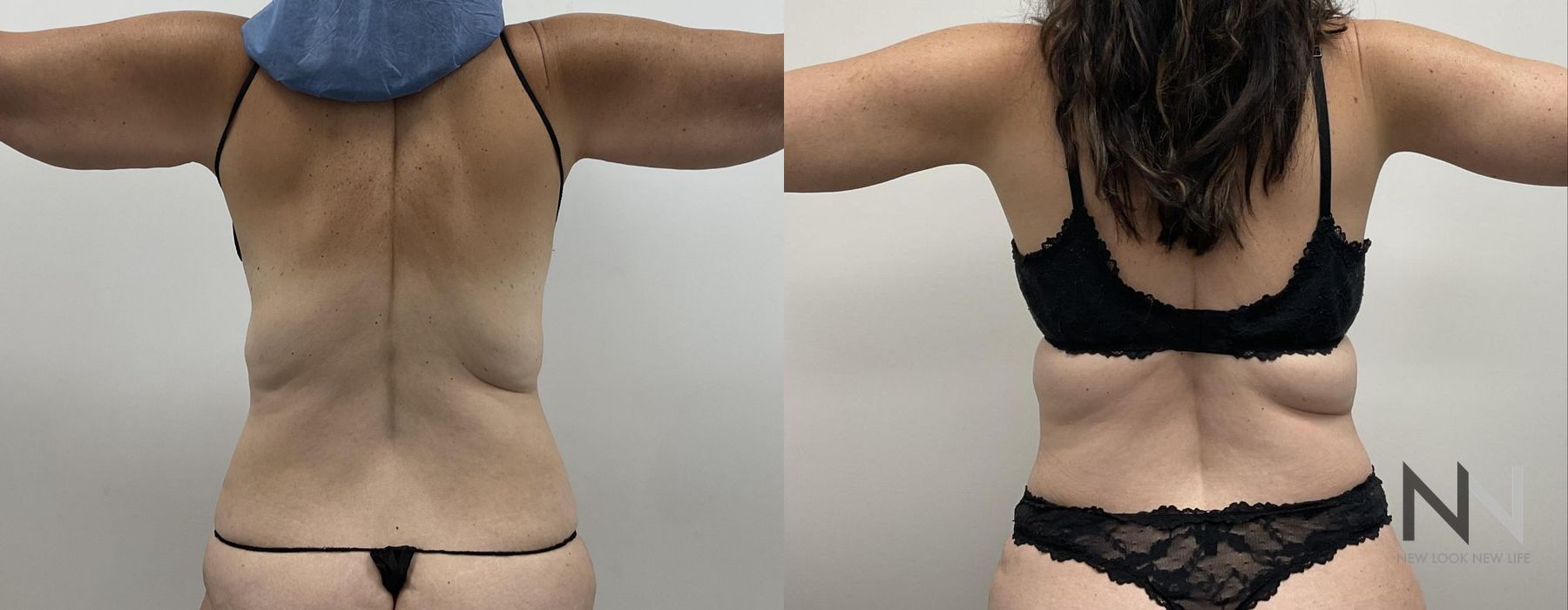 Tummy Tuck - Thumbnail 4