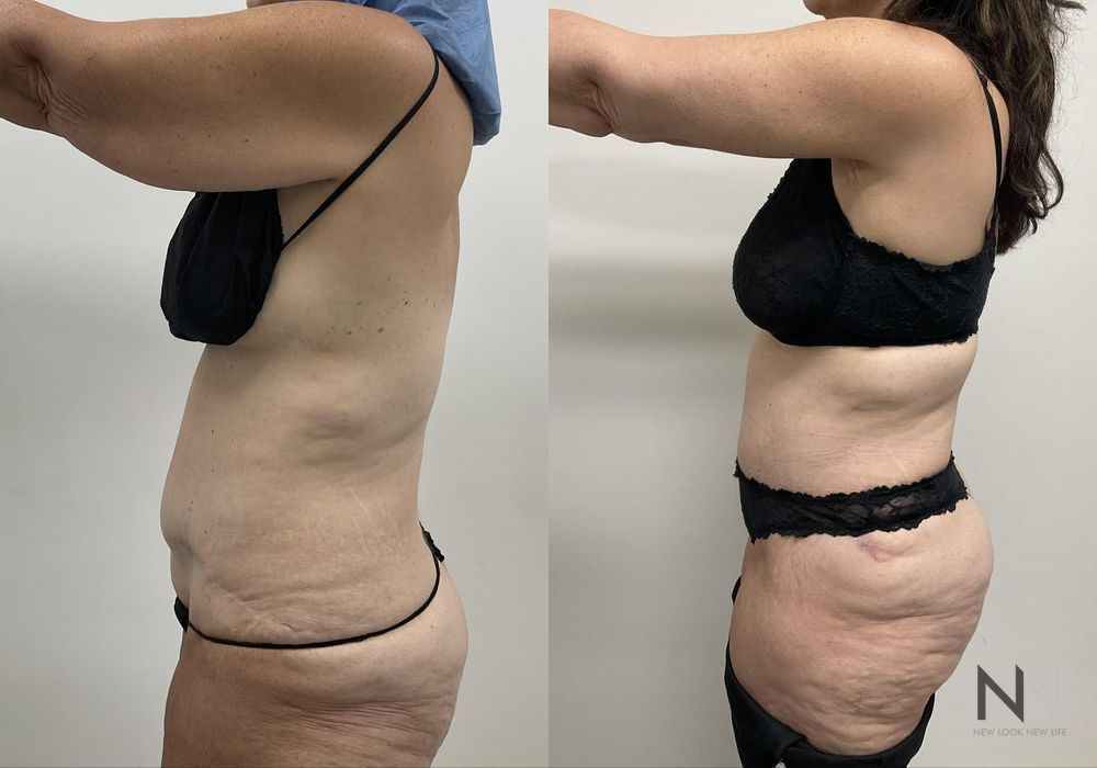 Tummy Tuck - Case 2122