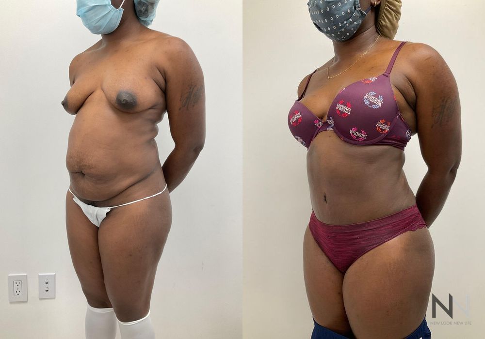 Tummy Tuck - Thumbnail 2