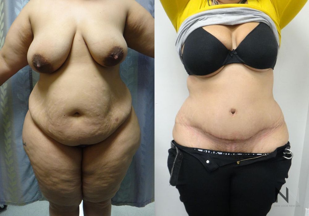 Tummy Tuck - Case 2117