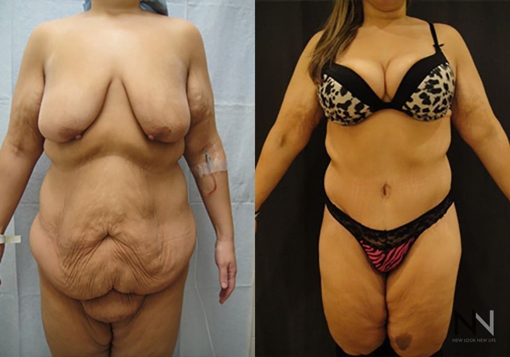 Tummy Tuck - Case 2109