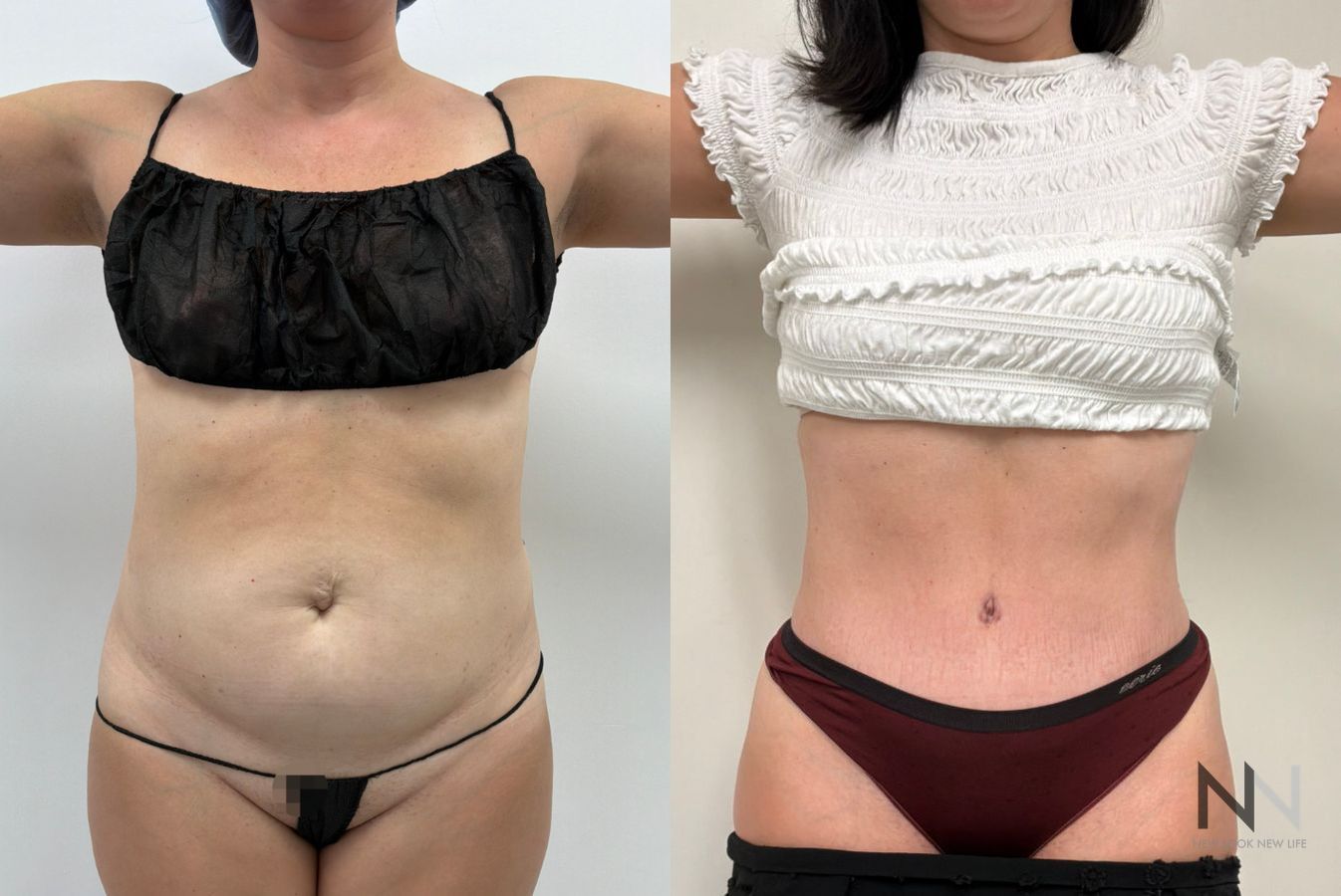 Abdominoplasty before and after showing improved abdominal contour and removal of excess skin by Dr. Claudia Kim in NYC.