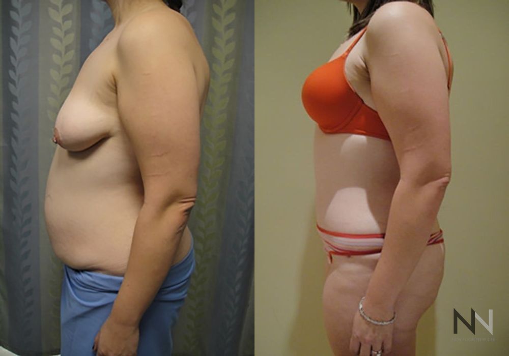 Tummy Tuck - Case 1910