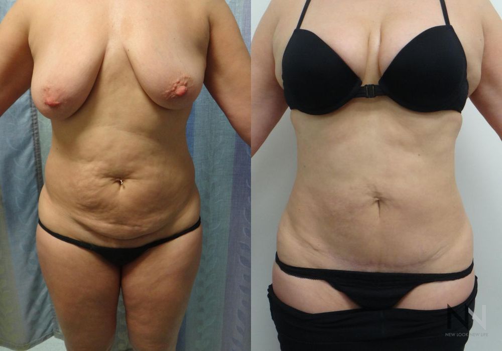 Tummy Tuck - Case 2100