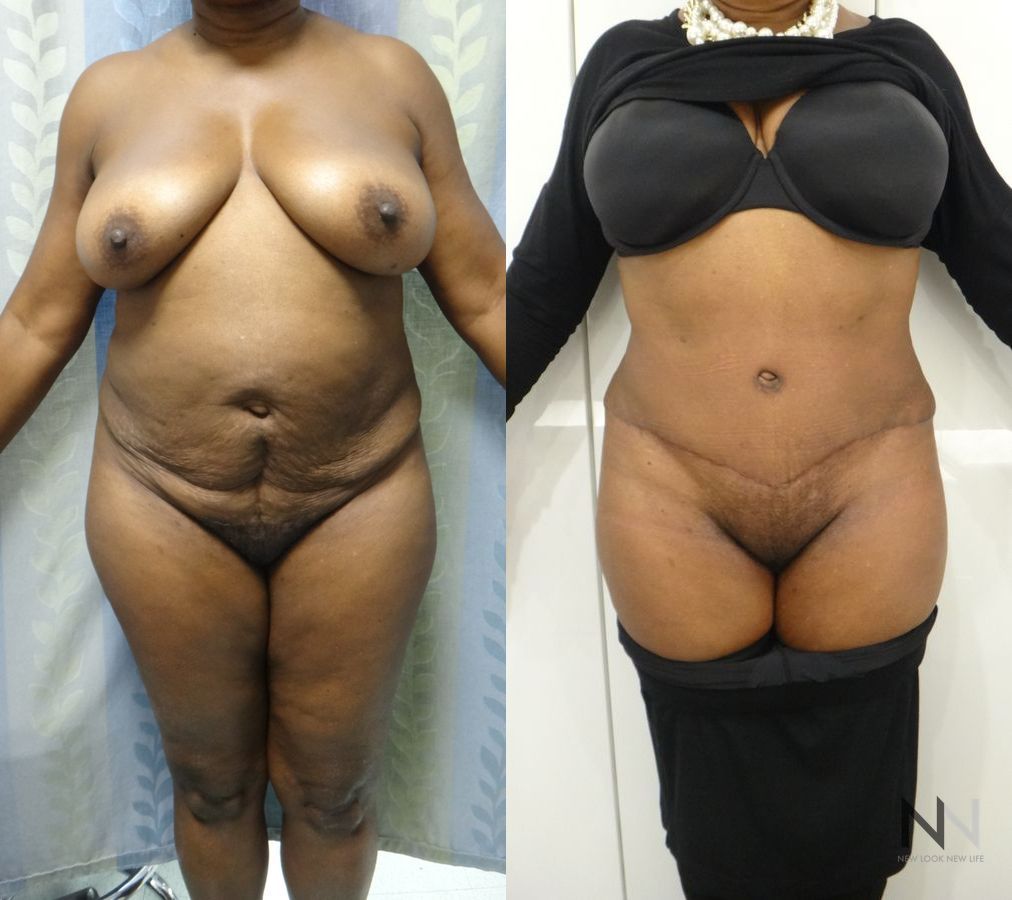Abdominoplasty showing flatter abdomen and tighter skin