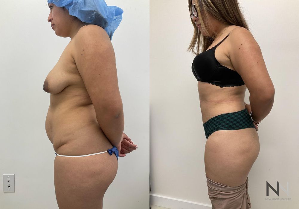 Tummy Tuck - Thumbnail 3