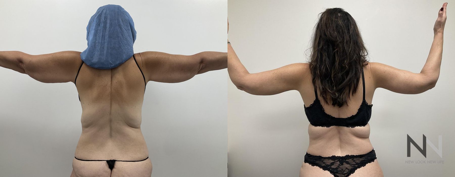 Tummy Tuck - Thumbnail 3