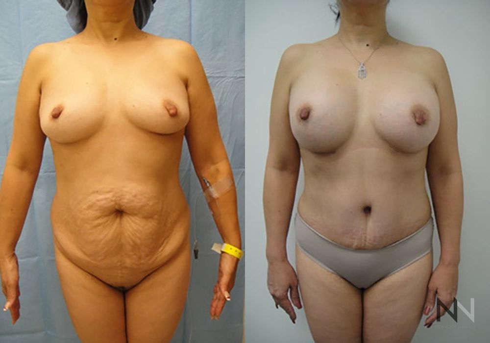 Tummy Tuck - Case 2101