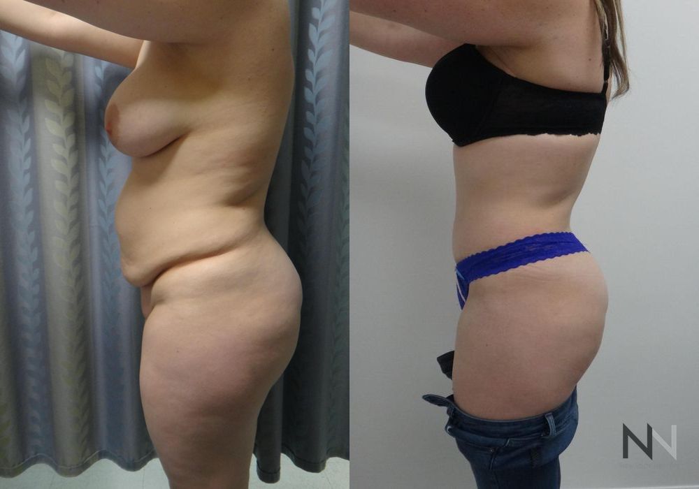 Tummy Tuck - Thumbnail 2