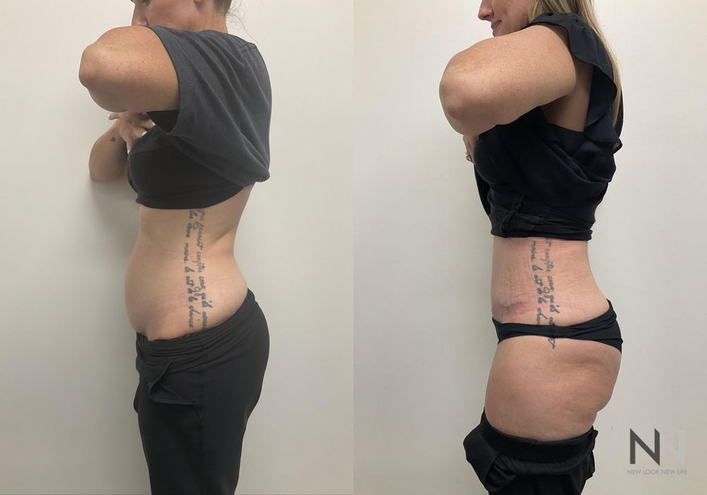 Tummy Tuck - Thumbnail 4