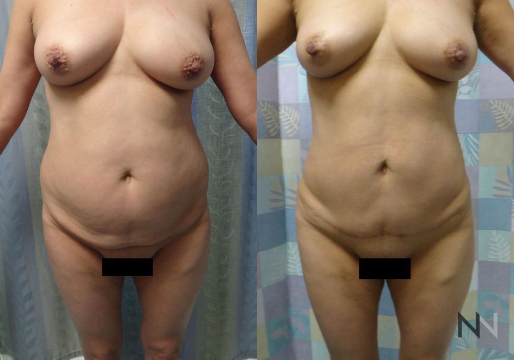 Tummy Tuck - Case 1933