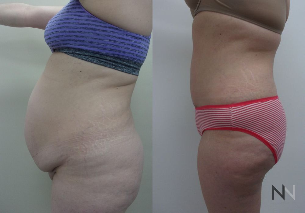 Tummy Tuck - Thumbnail 3
