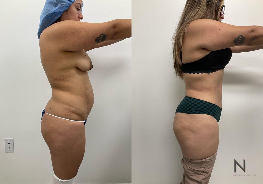 Tummy Tuck - Thumbnail 4