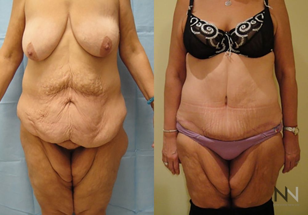 Tummy Tuck - Case 2096