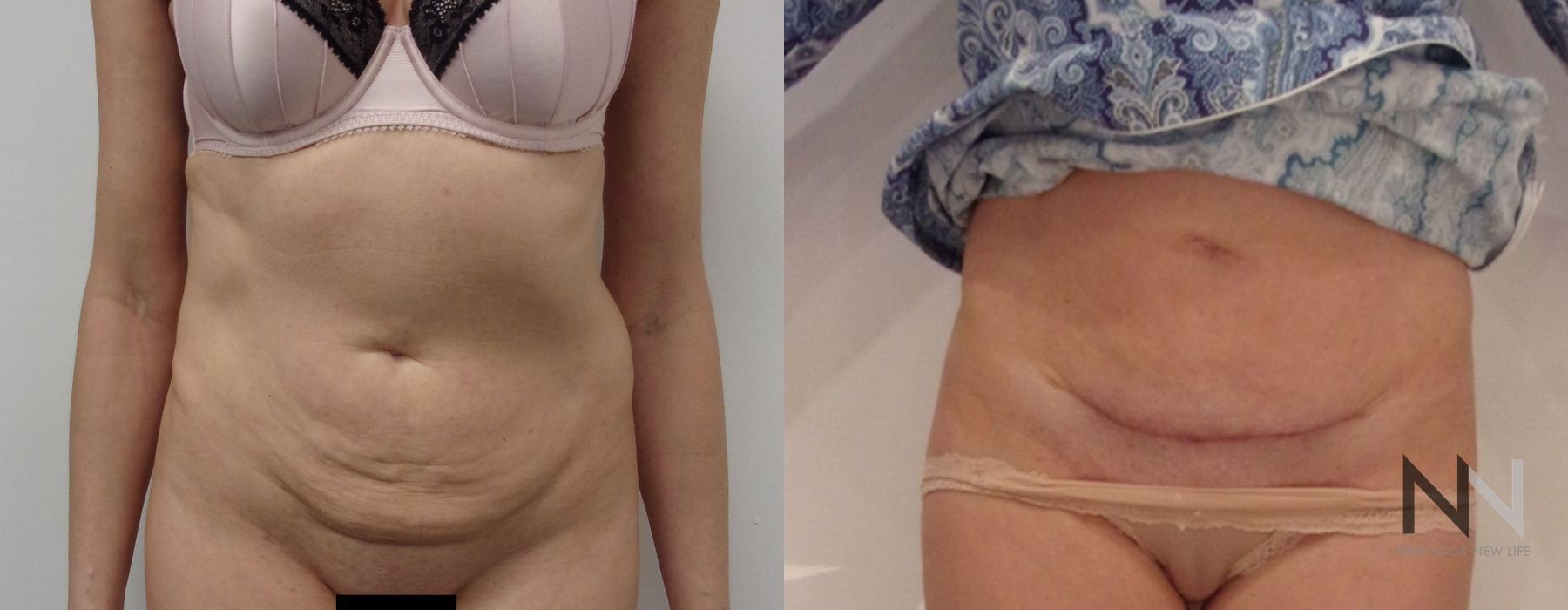Tummy Tuck - Case 2097