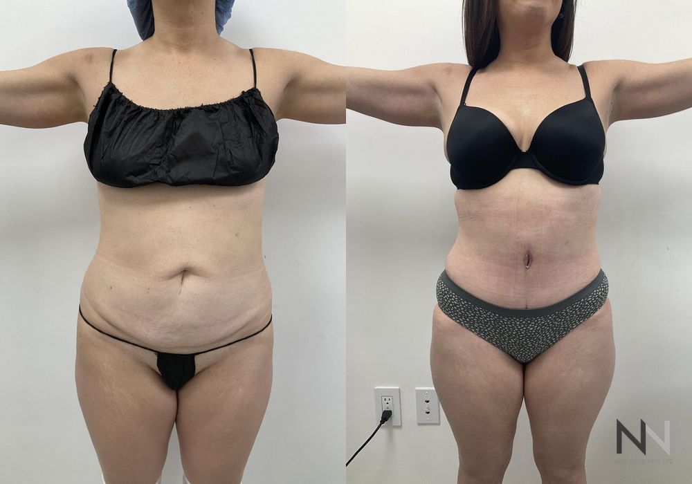 Tummy Tuck - Thumbnail 3