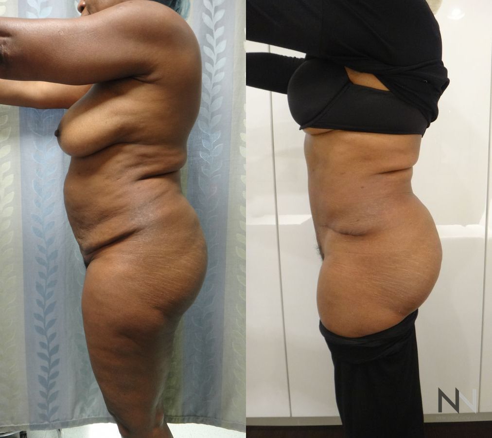 Abdominoplasty showing flatter abdomen and tighter skin - Angle 2