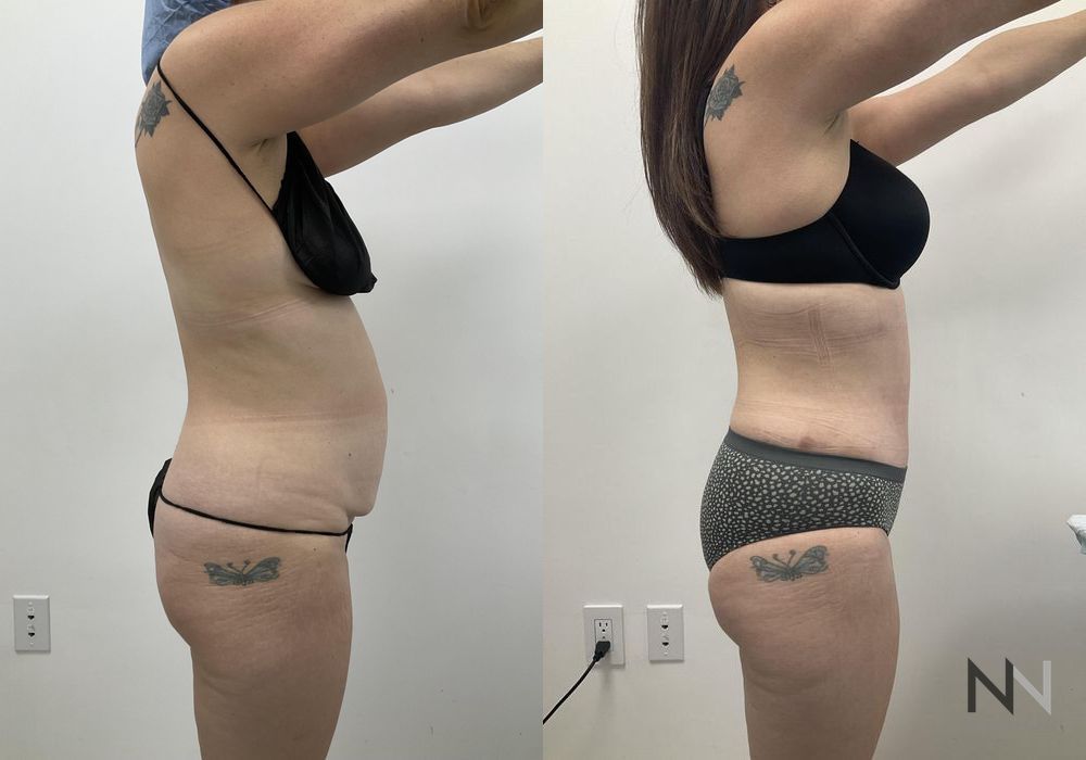 Tummy Tuck - Thumbnail 4