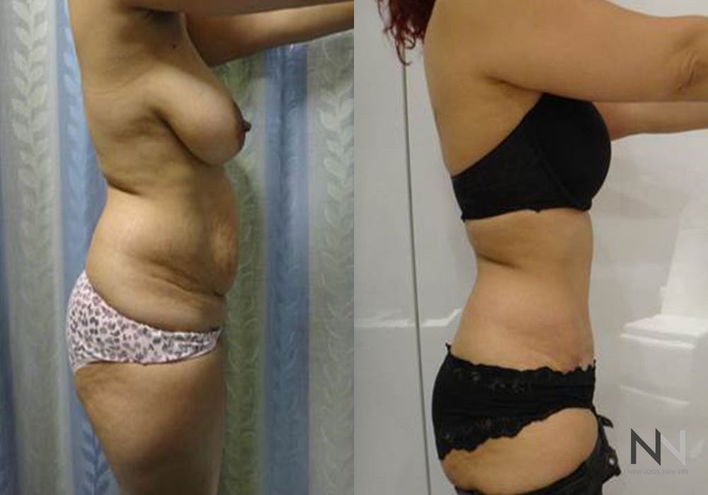 Tummy Tuck - Thumbnail 2