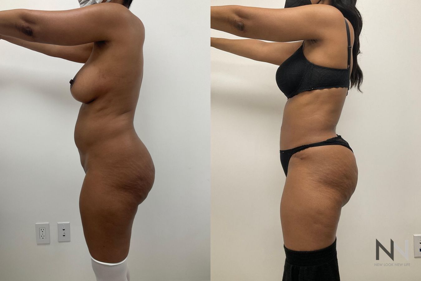 Abdominoplasty and liposuction showing improved contour - Angle 3