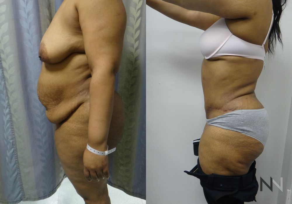 Tummy Tuck - Case 1923