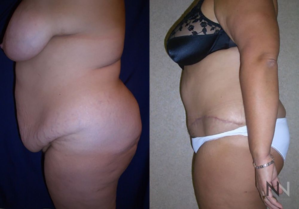 Tummy Tuck - Thumbnail 2