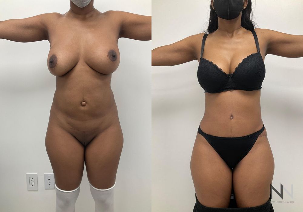 Tummy Tuck - Case 2084