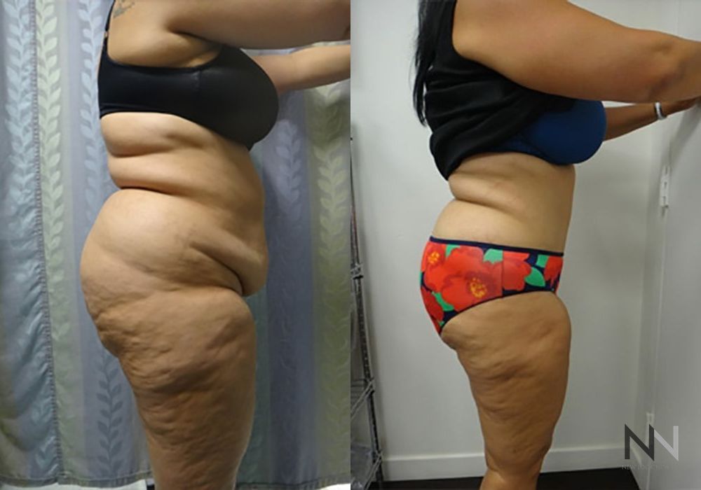 Tummy Tuck - Thumbnail 3