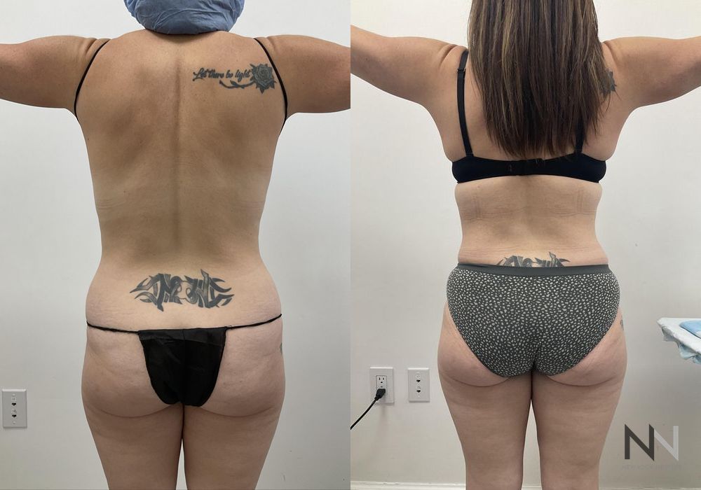 Tummy Tuck - Thumbnail 2