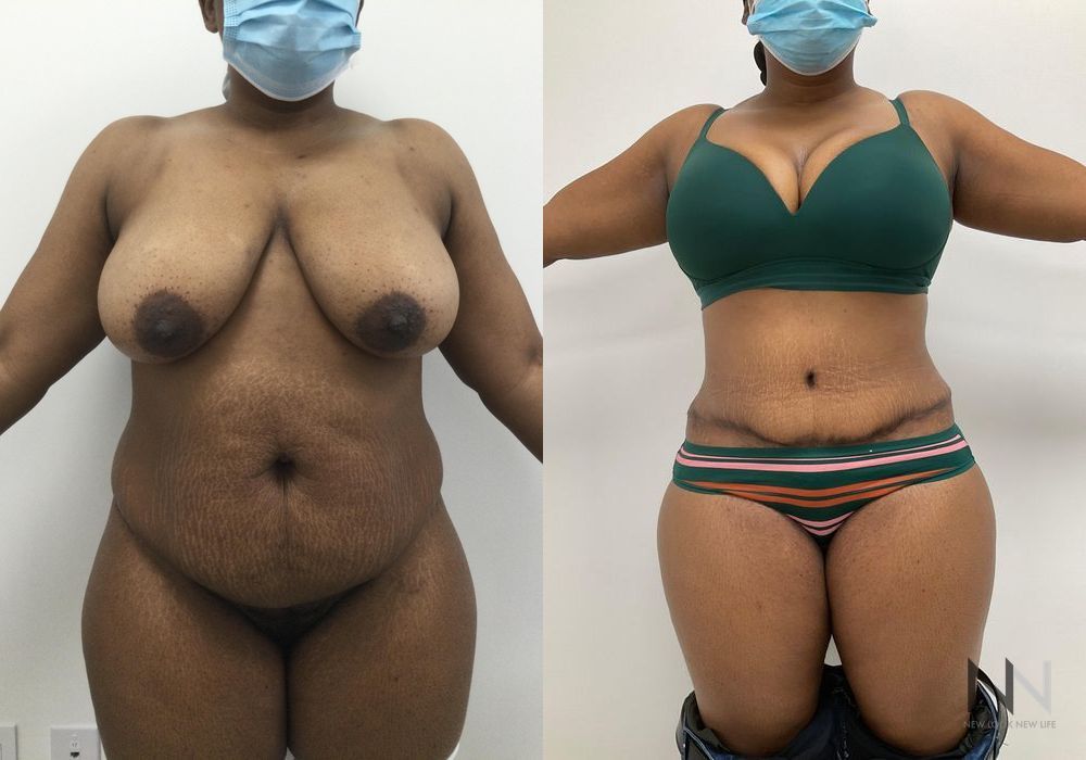 Tummy Tuck - Case 1901