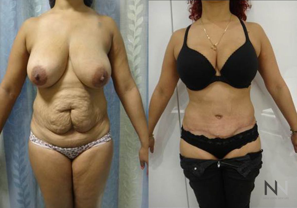 Tummy Tuck - Case 1925