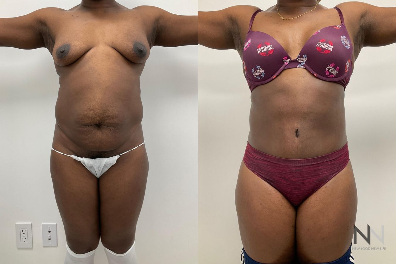 Before and after tummy tuck with liposuction six months