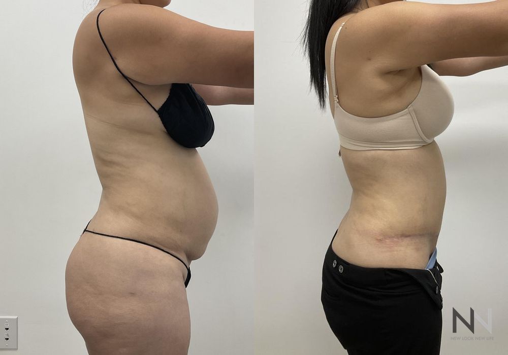 Tummy Tuck - Case 2119