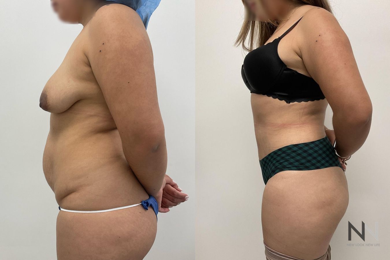 Before and after tummy tuck with flank liposuction - Angle 3