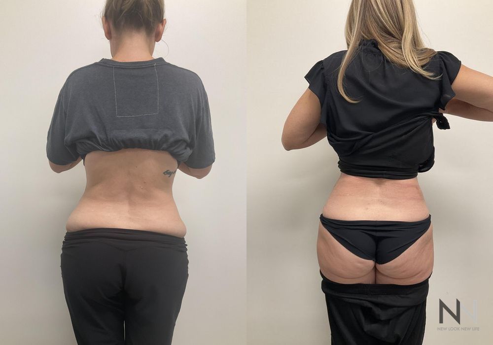 Tummy Tuck - Thumbnail 2