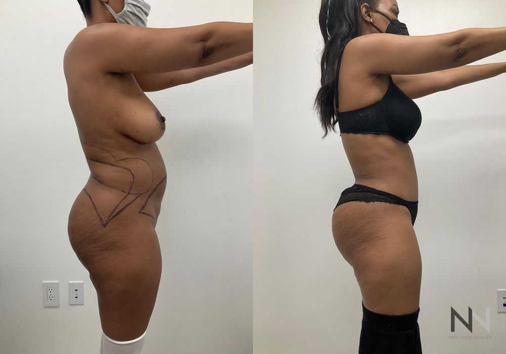 Tummy Tuck - Thumbnail 4