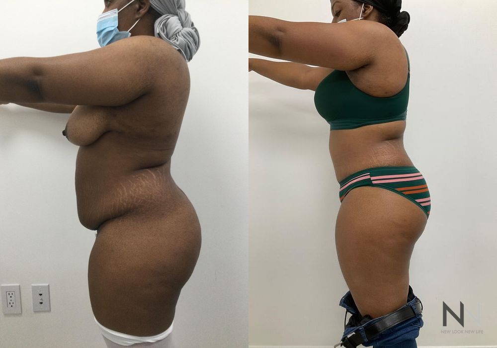 Tummy Tuck - Thumbnail 2