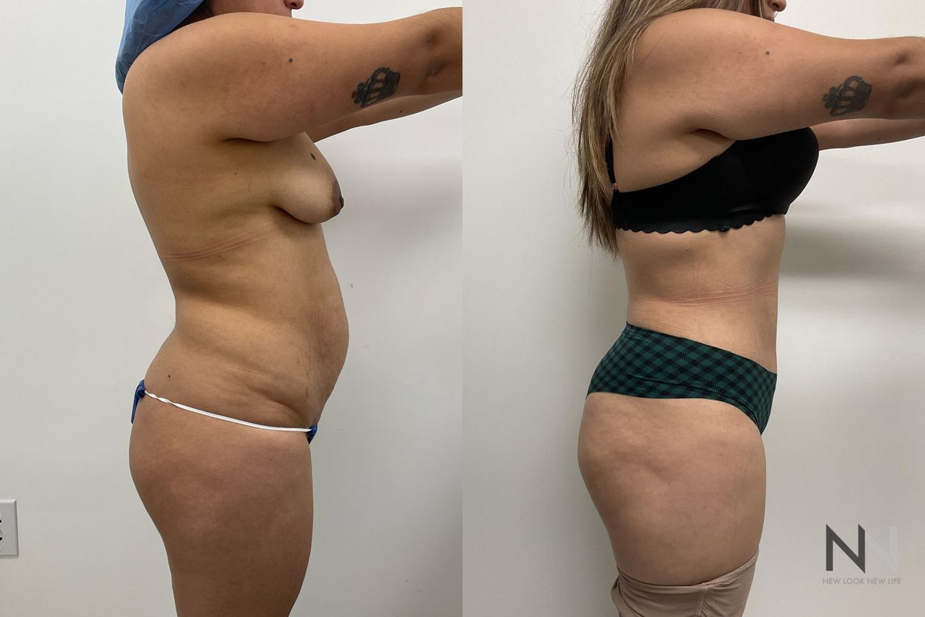 Before and after tummy tuck with flank liposuction - Angle 2
