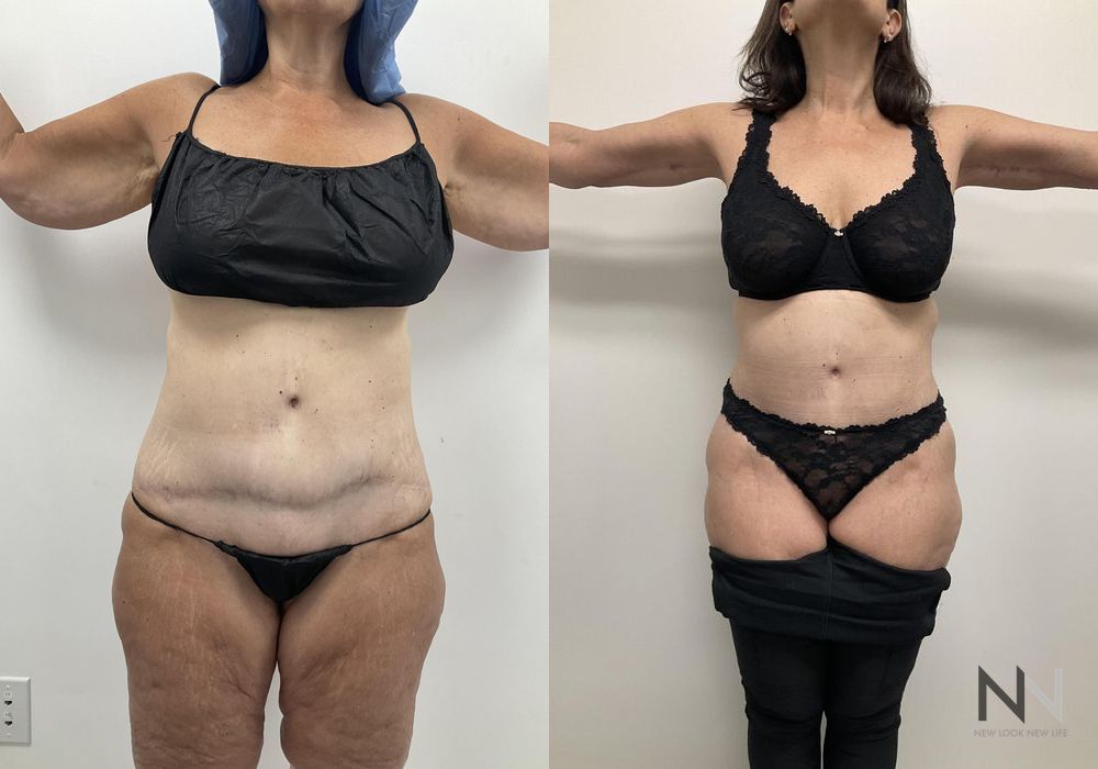 Tummy Tuck - Thumbnail 4