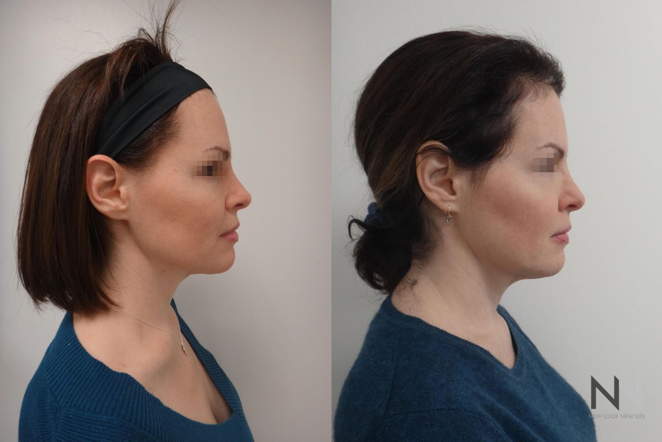 Lift & Tighten Naturally