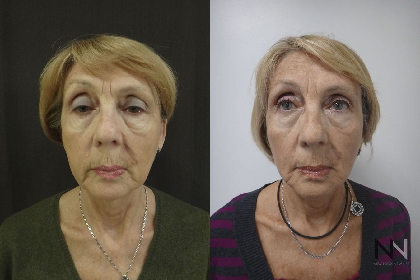 Before and after Ultherapy case 21295