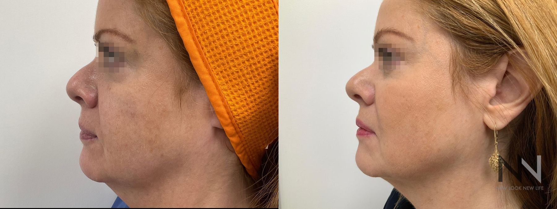 Before and after Ultherapy case 21332 - Angle 2