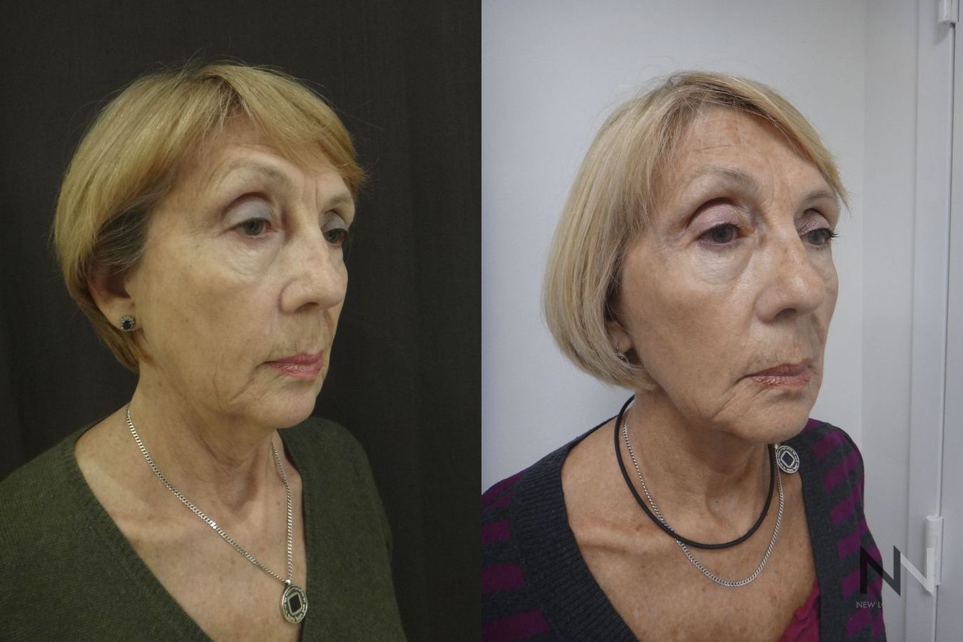 Before and after Ultherapy case 21295 - Angle 2