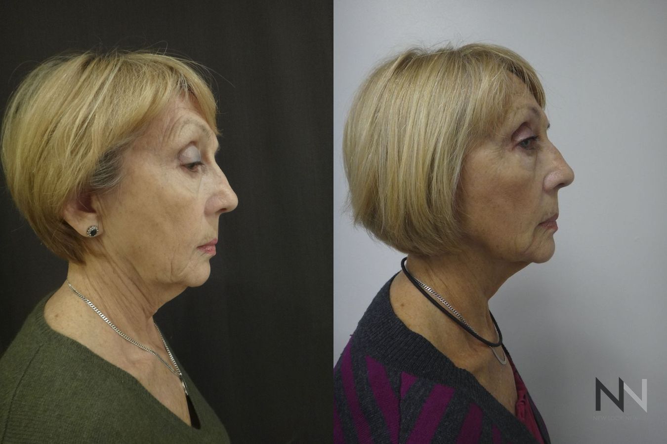 Before and after Ultherapy case 21295 - Angle 3
