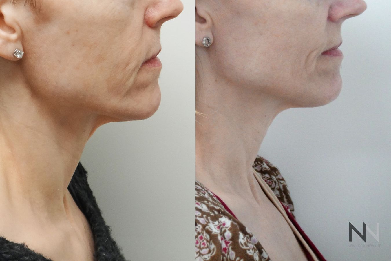 Before and after Ultherapy case 21289 - Angle 2