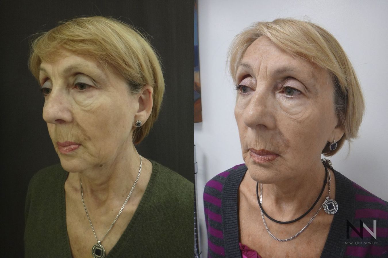 Before and after Ultherapy case 21295 - Angle 4